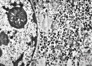 M, 62y. | pheochromocytoma